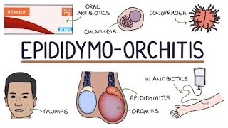 EpididymoOrchitis  epididymis [upl. by Niledam]