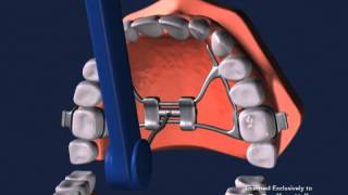 Advanced Orthodontics  Expanders [upl. by Nylhtac324]