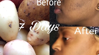 Acne Scars amp Hyperpigmentation  VCare Hair amp Skin Clinics  Skincare Tips [upl. by Lasley]