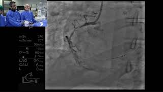 Endoluminal reconstruction of a diffusely diseased and tortuous RCA by Tejas Patel [upl. by Opiuuk670]