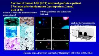 Stem Cell Therapy for Stroke  Gary Steinberg Stanford University [upl. by Gerhan275]