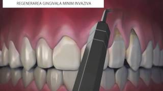 Regenerare gingivala minim invaziva [upl. by Lede]