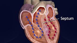 Hypertrophic Obstructive Cardiomyopathy Animation  Treatment Procedure for HOCM Video [upl. by Nahsad634]