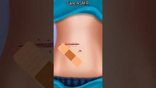 nonsurgical laser Varicose veins treatment satisfying asmr care shorts ytshorts [upl. by Ateekan859]