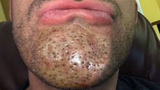 WARNING Blackheads amp Dilated Pores of Winer  Bubu Plus Documentary [upl. by Hamitaf452]