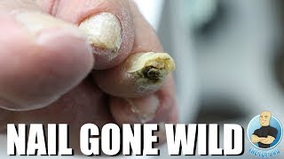 HAMMERTOE GONE WILD DAMAGED TOENAIL  HARD SKIN BUILD UP [upl. by Hailat]