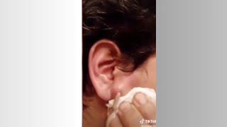 Popping huge blackheads and Pimple Popping  Best Pimple Popping Videos 21 [upl. by Auoy498]