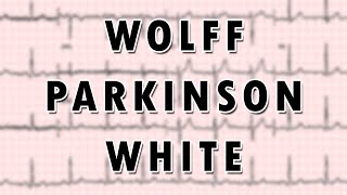 WolffParkinsonWhite Syndrome [upl. by Ymmas809]