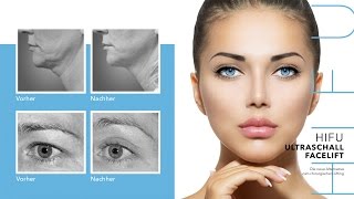 HIFU Ultraschall Facelift  Mit Ultraschall Gesicht behandeln [upl. by Dyraj541]