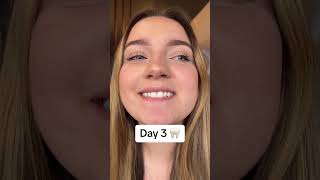 7 Day Teeth Transformation lifestyle tiktok teethwhitening beauty selfcare shorts wow [upl. by Arualana]