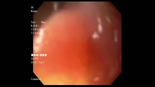 Colocación de videocápsula endoscópica por endoscopia [upl. by Margherita]