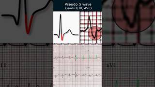 AVNRT ECG Pseudo S wave [upl. by Nich122]