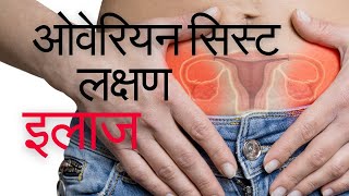 Ovarian cyst ke lakshan  Ovarian cyst kaise thik kare  ओवरी में गाँठ  Ovarian cyst kya hota hai [upl. by Ecitsuj]