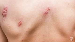 Mayo Clinic Minute Dont suffer with shingles [upl. by Nayab]