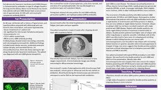 Double positive GBM and p ANCA [upl. by Rupert407]