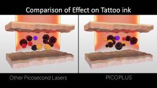 Luntronic PICOPLUS Laser FDA approved Picosecond amp Nanosecond Platform [upl. by Yong150]