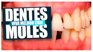 Se você tem Dentes Moles PERIODONTITE você precisa assistir esse video [upl. by Ecydnac]