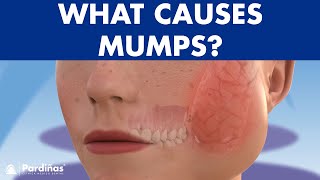 Mumps parotitis and other salivary glands conditions sialadenitis sialolithiasis mucocele © [upl. by Acirret]