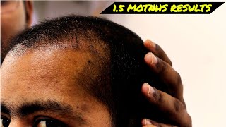 Hair Transplant 15 Months Results in India 2024  Hair Loss Permanent Solution  Hair Growth 2024 [upl. by Casimir]