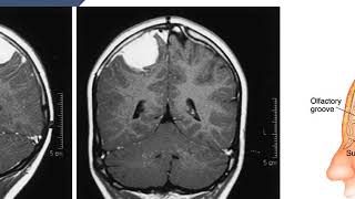 Generalidades de tumores cerebrales [upl. by Lister]