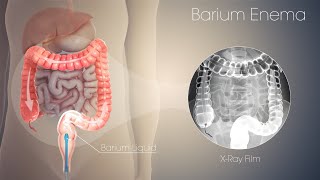 Barium Enema  how i do barium enema x ray  easy way to perform the x ray barium enema [upl. by Bernadina]