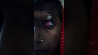 recorrent episcleritis from 2 years youtubeshorts shortvideo episcleritis eyedoctor doctor [upl. by Caniff447]