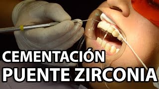 Cementación Puente Zirconia 6 Unidades👅Parte2 [upl. by Drofxer]