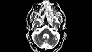 Cavernoma [upl. by Nick]