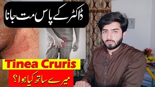 Private Part itching  Tinea Cruris  Fungle Infection  Babar Ali Hashmi [upl. by Novanod658]