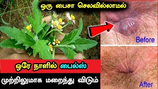 ஒரு பைசா செலவில்லாமல் ஒரே நாளில் பைல்ஸ் முற்றிலுமாக மறைந்து விடும்  Piles Treatment in Tamil Piles [upl. by Eigger711]