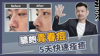 膿皰青春痘5天快速痊癒，學會這秘訣，痘痘好超快！！【77老大】 [upl. by Hgielrac]