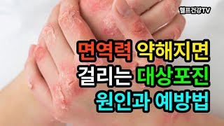 대상포진 원인과 예방법 대상포진 shingles [upl. by Aicilanna958]