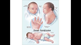 Down Syndrome  Autosomal Trisomies  USMLE step 1  Lecture 11 [upl. by Dodd607]