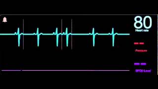 10 Extrasistole auricular [upl. by Emilie]