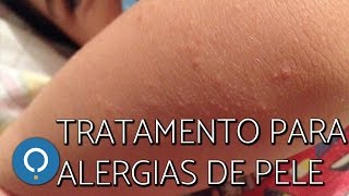 DERMATITE ATÓPICA EM CRIANÇAS  INFLAMAÇÃO NA PELE  MACETES DE MÃE [upl. by Elwaine760]