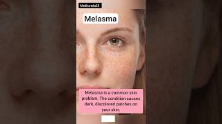 Melasma क्या है  pictures [upl. by Sukin]