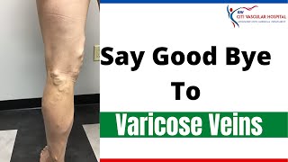 Varicose veins  Treating Varicose veins without surgery in hyderabad [upl. by Leagiba]