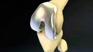 Biomet Vanguard Total Knee Replacement Animation [upl. by Arutnev]