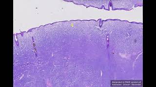 Button tumour or Canine Cutaneous Histiocytoma  Histopathology  Vanessa Herder [upl. by Kecaj]