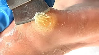 Callus removal from feetampFoot scraping dead skin【Xiao Yan pedicure】stress 615 [upl. by Vinna]