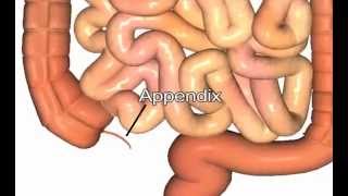 Appendectomy Surgery for Appendicitis removal of appendix [upl. by Alue]