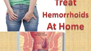 How To Treat HEMORRHOIDS At Home Quickly amp Naturally Without Surgery [upl. by Ecyrb]