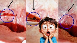 Tonsil Stone Removal Procedure Irritable but Difficult to remove why it Fails [upl. by Damalas]