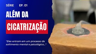 Além da Cicatrização Curativo á Vácuo  EP 1 [upl. by Pillyhp]