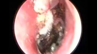 Severe Fungal Ear Infection cleaning by suction irrigation [upl. by Elokkin110]