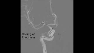 Single Microcatheter Coiling [upl. by Arriet]