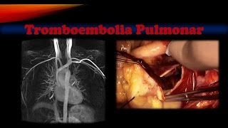 Tromboembolia pulmonar [upl. by Reyotal]