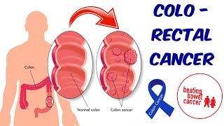 Colon Cancer [upl. by Bernete505]