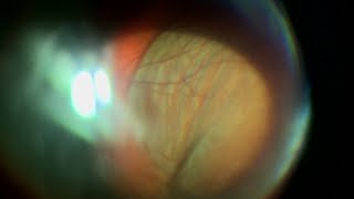 Aphakic eye with hypotony and wrinkly choroidal effusion [upl. by Enirehs]