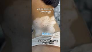 VITILIGO PERMANENT COSMETIC TATTOOING  VITILIGO TREATMENT  vitiligoindia whitespottreatment [upl. by Frasier]